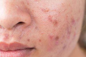 Accutane Acne Drug Widely 'Overused' Says UK Dermatologist